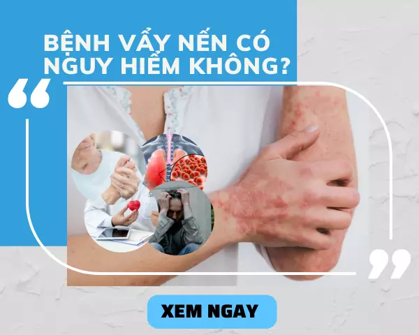 Giải đáp: Bệnh vảy nến có nguy hiểm không? TÌM HIỂU NGAY!